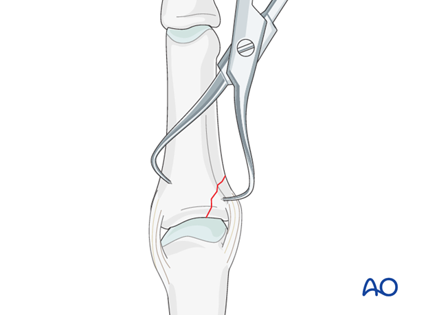 Avulsion fracture of proximal phalanx MCP joint – Screw fixation