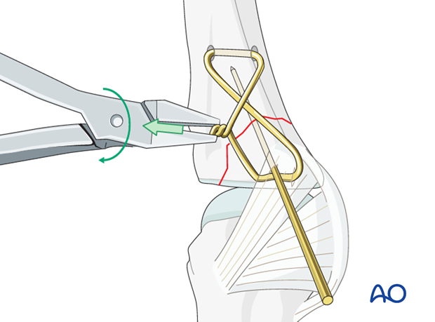 Avulsion fracture of proximal phalanx MCP joint – Tension-band wiring
