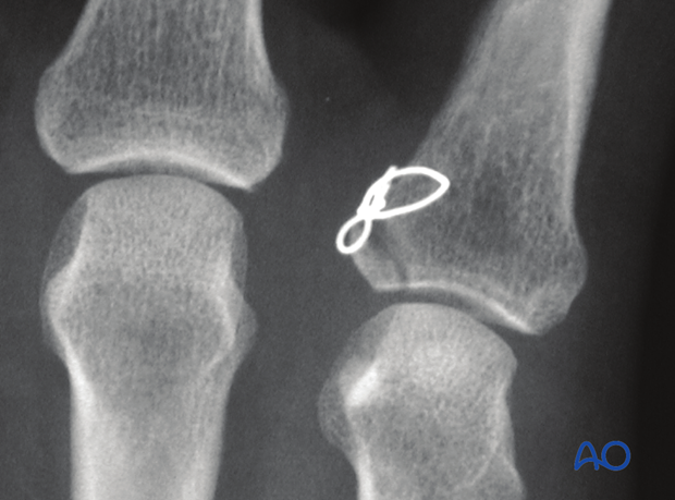 Avulsion fracture of proximal phalanx MCP joint – Tension-band wiring