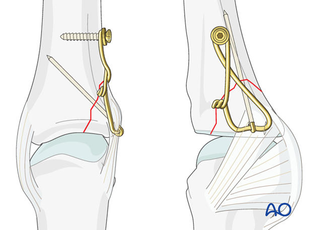 Avulsion fracture of proximal phalanx MCP joint – Tension-band wiring