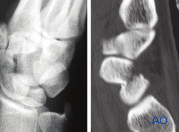 Scaphoid – Undisplaced waist fracture – Percutaneous screw fixation