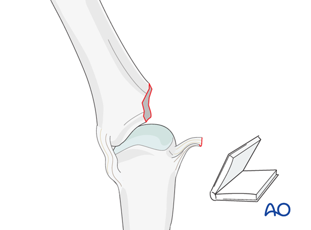 Avulsion fracture of proximal phalanx MCP joint – Collateral ligament reattachment