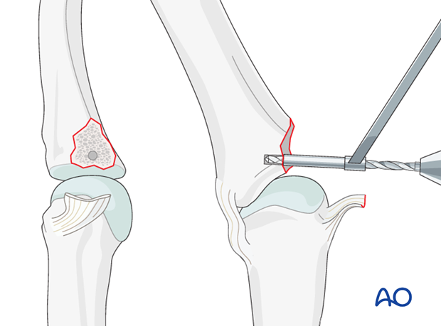 Avulsion fracture of proximal phalanx MCP joint – Collateral ligament reattachment