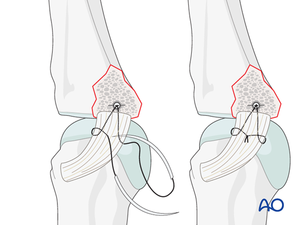 Avulsion fracture of proximal phalanx MCP joint – Collateral ligament reattachment