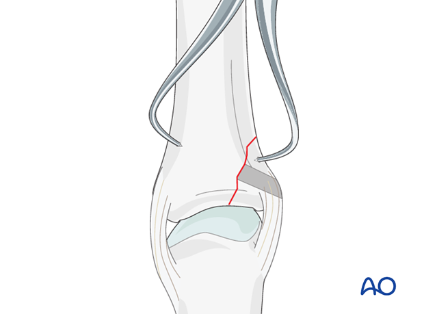 Avulsion fracture of proximal phalanx MCP joint – Screw fixation