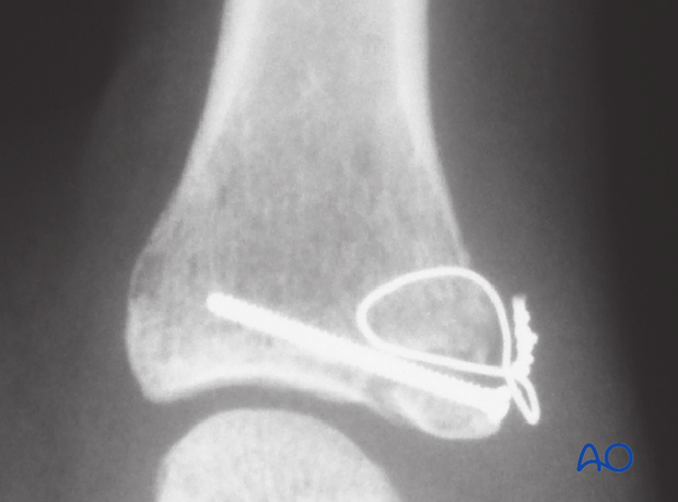 Avulsion fracture of proximal phalanx MCP joint – Screw fixation