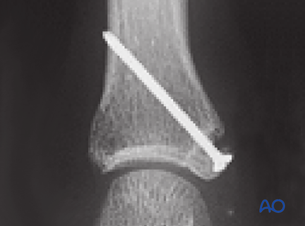 Avulsion fracture of proximal phalanx MCP joint – Screw fixation