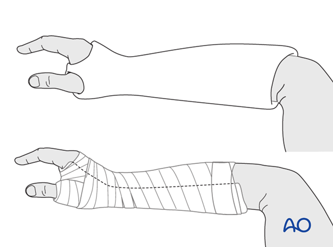 Nonoperative treatment for Metacarpal, Bennett fracture