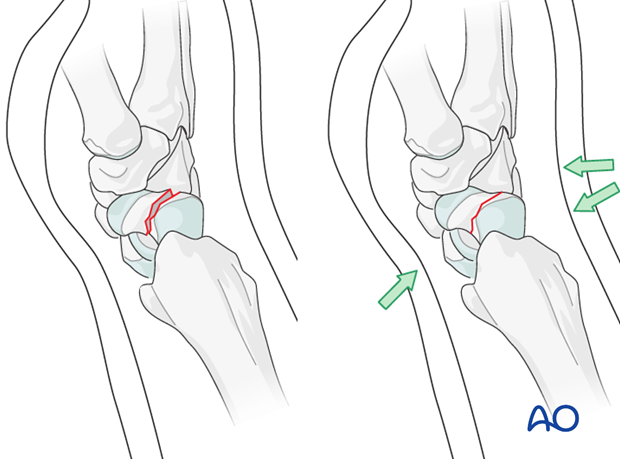 Scaphoid Undisplaced waist fracture Nonoperative treatment