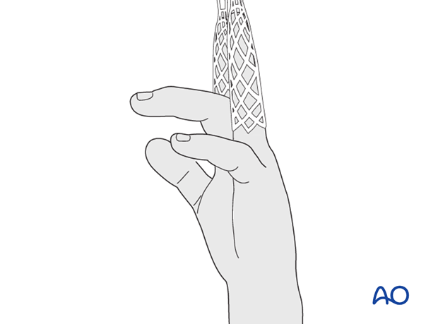 Proximal phalanx - MCP joint - vertical shearing fracture - Lag screw fixation
