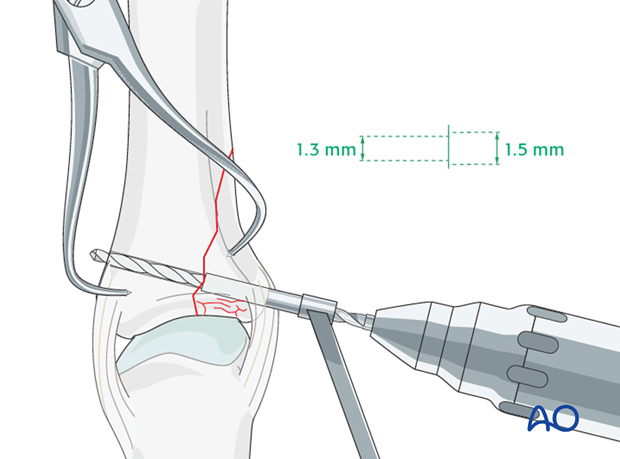 Proximal phalanx - MCP joint - vertical shearing fracture - Lag screw fixation