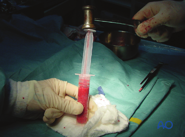 Impact the bone graft using a mallet to compress the syringe plunger. This results in a high concentration of bone cells, ...