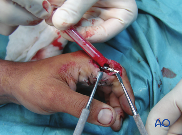 The bottom of the syringe is cut off using a scalpel. Insert the compacted bone graft into the cavity by pressure on the ...