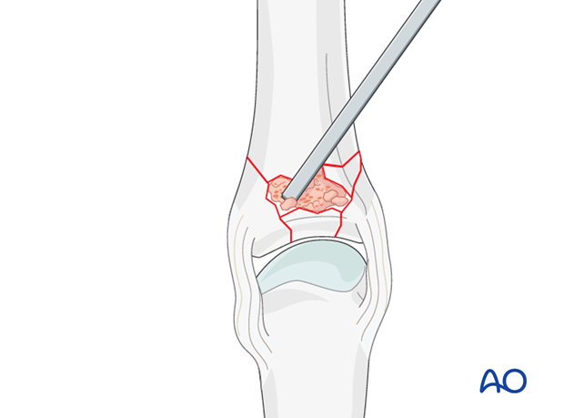 Multifragmentary proximal phalanx MCP joint fracture – plate fixation