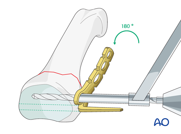 Multifragmentary proximal phalanx MCP joint fracture – minicondylar bridge plate fixation