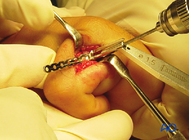 Transverse fracture of the base of the proximal phalanx – Minicondylar plate fixation