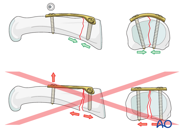 Multifragmentary proximal phalanx MCP joint fracture – T-plate fixation