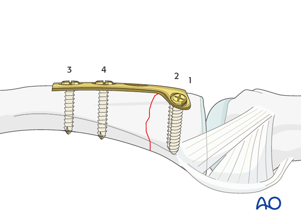 Transverse fracture of the base of the proximal phalanx – T-plate fixation