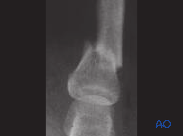 Transverse fracture of the base of the proximal phalanx – Plate fixation