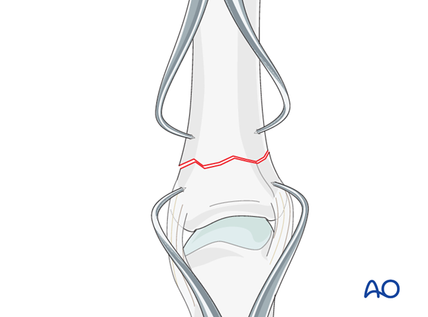 Transverse fracture of the base of the proximal phalanx – Plate fixation