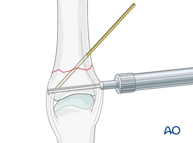 Transverse fracture of the base of the proximal phalanx – Plate fixation