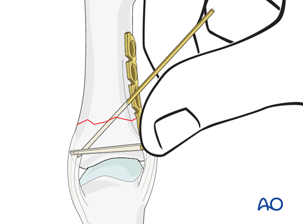 Transverse fracture of the base of the proximal phalanx – Minicondylar plate fixation