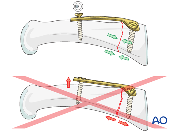 Transverse fracture of the base of the proximal phalanx – T-plate fixation