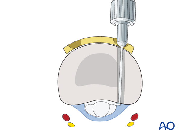 Transverse fracture of the base of the proximal phalanx – T-plate fixation