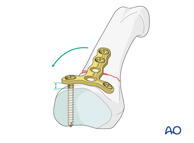 Transverse fracture of the base of the proximal phalanx – T-plate fixation