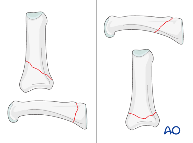 Metaphyseal simple oblique fracture of proximal phalanx – Plate fixation 
