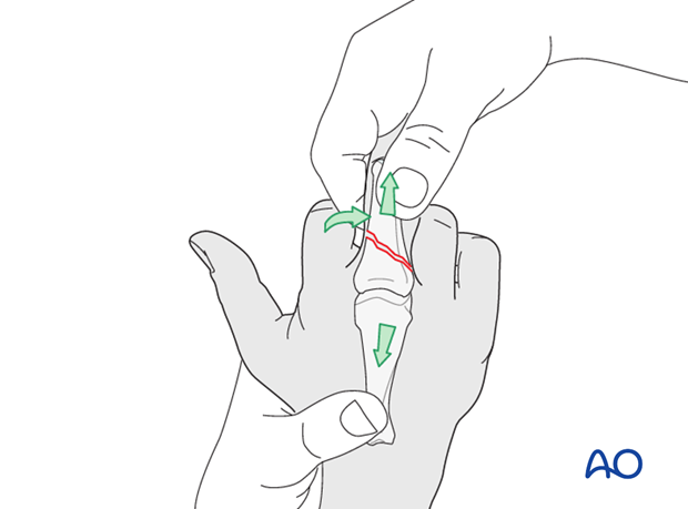Metaphyseal simple oblique fracture of proximal phalanx – Plate fixation 
