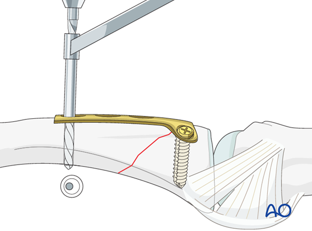 Metaphyseal simple oblique fracture of proximal phalanx – T-plate fixation 