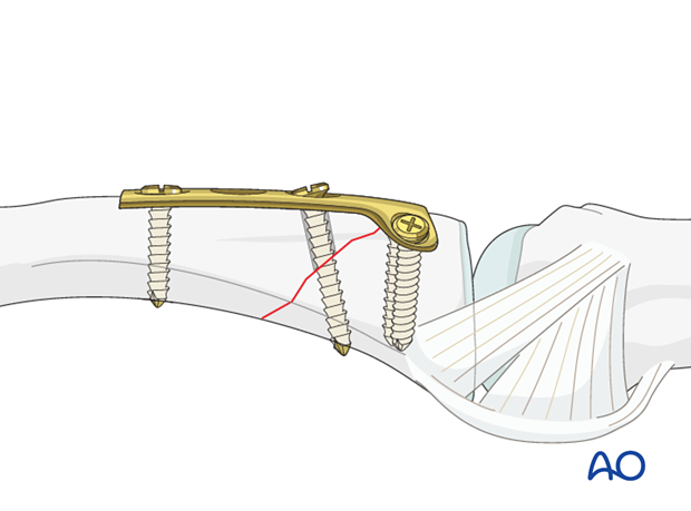 Metaphyseal simple oblique fracture of proximal phalanx – T-plate fixation 