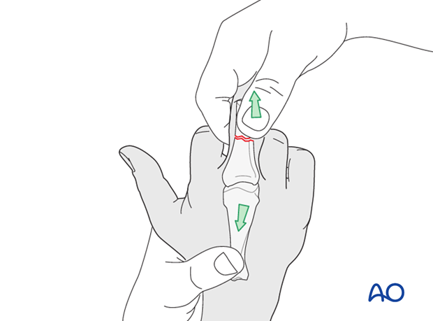 Comminuted fracture of the proximial phalanx meetaphysis – minicondylar bridge plate fixation