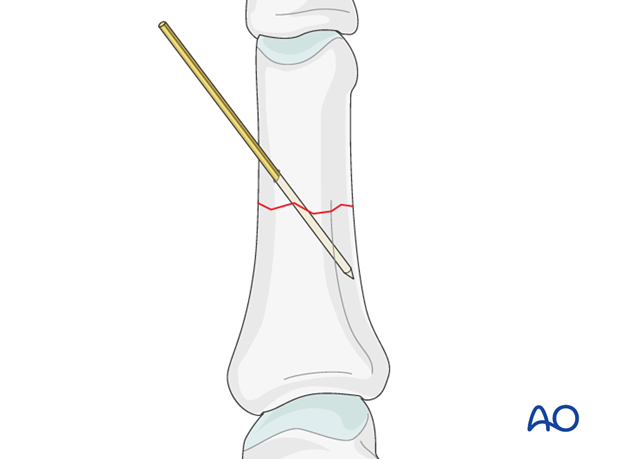 Simple transverse fracture of proximal phalanx – Compression plate fixation