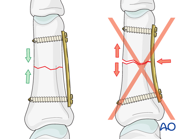 Simple transverse fracture of proximal phalanx – Compression plate fixation