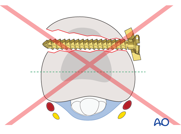 If the plate is not properly aligned in the lateral view, the screws may not cross the medullary canal and may not have ...