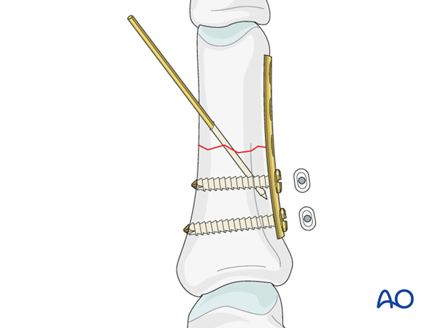Simple transverse fracture of proximal phalanx – Compression plate fixation