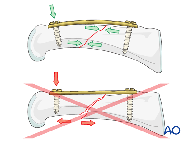 Short oblique shaft fractures of the proximal phalanx – Compression plate fixation