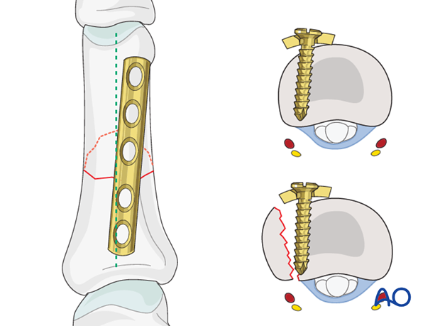 Short oblique shaft fractures of the proximal phalanx – Compression plate fixation