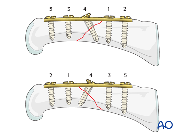 Short oblique shaft fractures of the proximal phalanx – Compression plate fixation