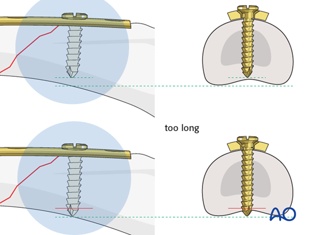 Short oblique shaft fractures of the proximal phalanx – Compression plate fixation