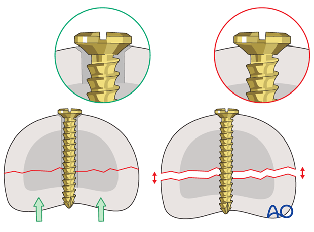 Long oblique head fracture of the proximal phalanx – Lag screw fixation 