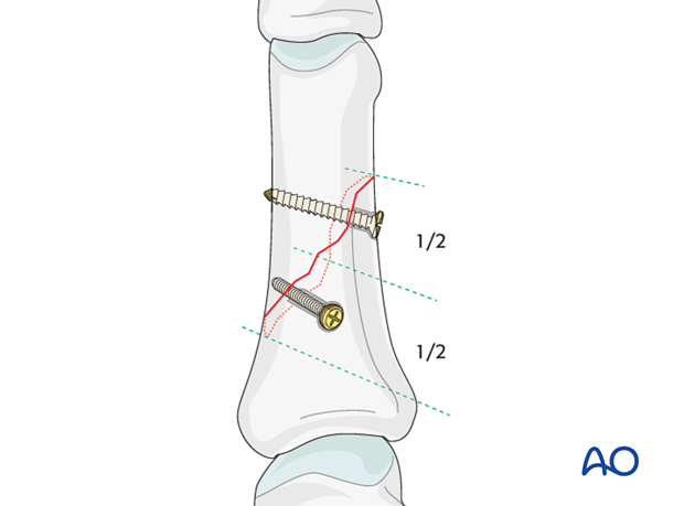 Long oblique and spiral shaft fractures of the proximal phalanx – Lag screw fixation
