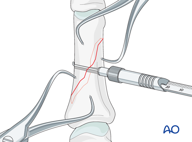 Long oblique and spiral shaft fractures of the proximal phalanx – Lag screw fixation