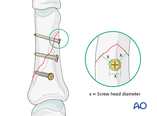 Long oblique and spiral shaft fractures of the proximal phalanx – Lag screw fixation