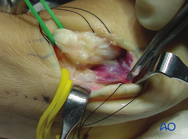 Preserving a small part of the insertion will later help with reattachment of the thenar muscles.