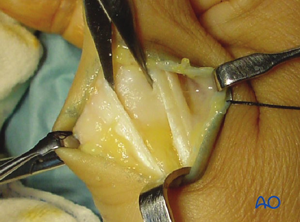 Be careful not to detach the insertion of the EPB from the base of the proximal phalanx.