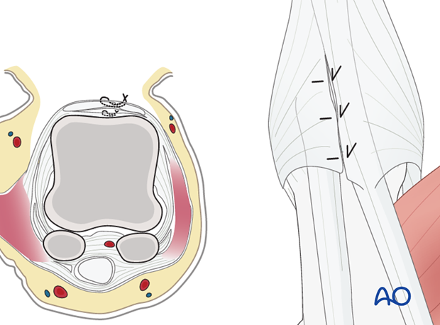 Repair the capsulotomy with fine, interrupted mattress sutures. The separated tendons of EPL and EPB are approximated with ...