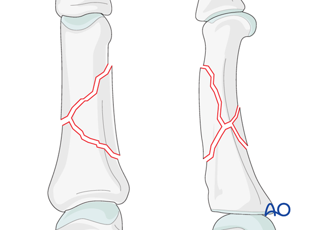 Wedge fractures of the proximal phalanx - Bridge plate fixation